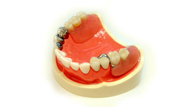 マルチコンアタッチメント義歯・アタッチメントの入れ歯
