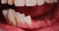 前歯と奥歯が無い状態・入れ歯