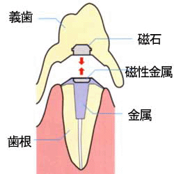 磁石式入れ歯の構造