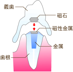 入れ歯を世界一強力なネオジューム磁石で固定・港区麻布十番