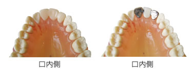 入れ歯のアタッチメント歯を削らないブリッジ・麻布十番の白宝デンタルクリニック