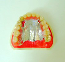 金属の入れ歯・チタン義歯・麻布十番の歯科医院